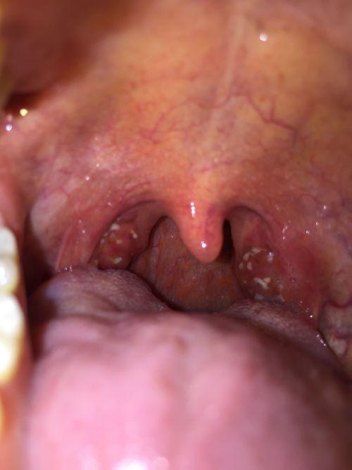 吃白瓜引起喉咙不适,揭秘原因及应对策略